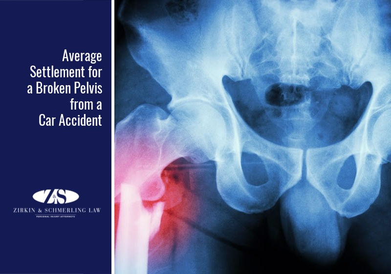Average Settlement For a Broken Pelvis from a Car Accident