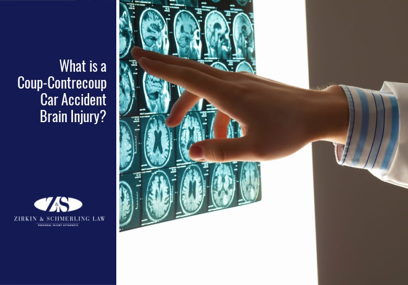 What is a Coup-Contrecoup Car Accident Brain Injury?