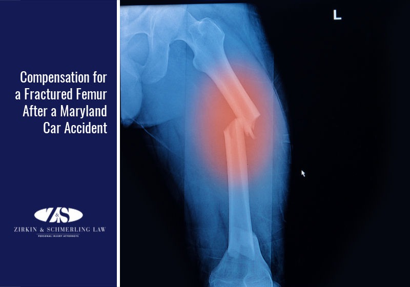 Compensation for a Fractured Femur After a Maryland Car Accident