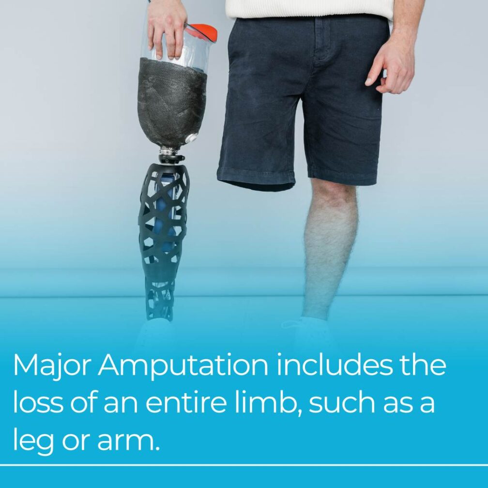 Amputation Injury Attorney in Maryland | Zirkin & Schmerling