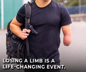 limb loss life-changing