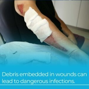 debris in wounds